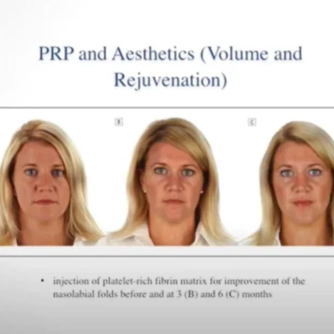 Platelet Rich Plasma (PRP) Platelet Rich Fibrin Matrix (PRFM) in Regenerative Medicine Video Course