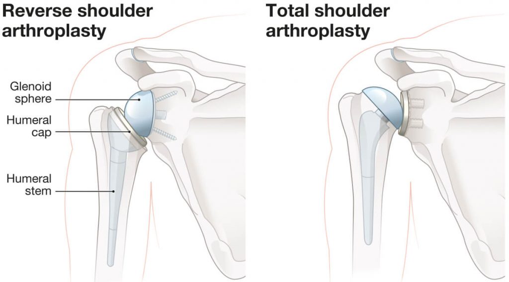Illustration showing reverse shoulder arthroplasty and total shoulder arthroplasty