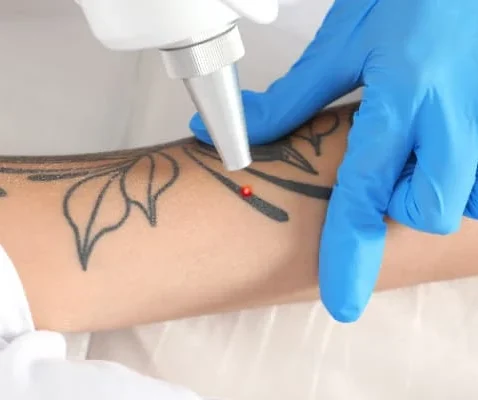 Pigment & Tattoo Laser Removal